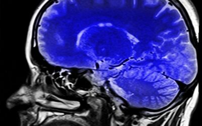 LA DEMENCIA VASCULAR, SEGUNDA CAUSA DE DEMENCIA TRAS EL ALZHEIMER