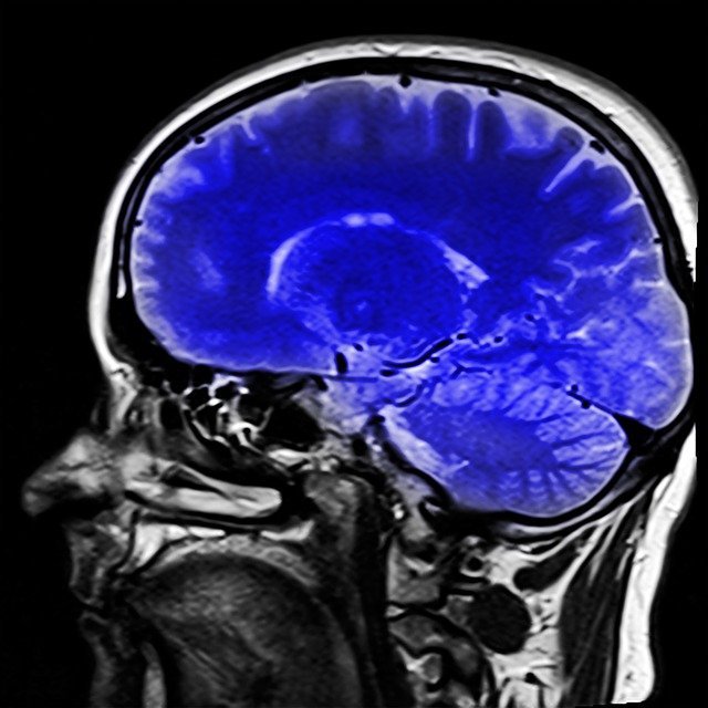 LA DEMENCIA VASCULAR, SEGUNDA CAUSA DE DEMENCIA TRAS EL ALZHEIMER
