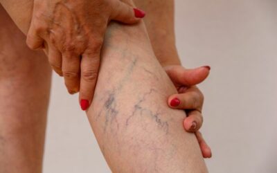 VARICES, ¿CÓMO PREVENIR SU APARICIÓN?