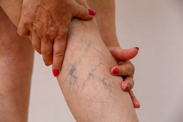 VARICES, ¿CÓMO PREVENIR SU APARICIÓN?